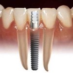 implantes-dentales1